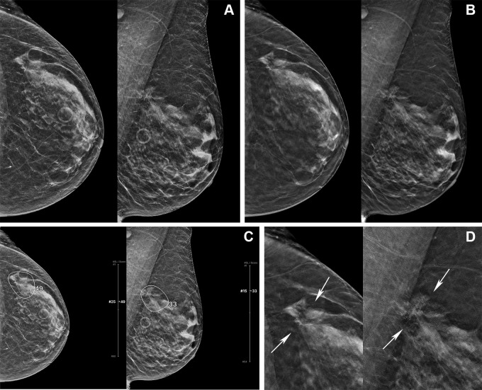 Digital mammography (DM) and digital breast tomosynthesis (DBT) images in a 72-year-old woman. (A) Left craniocaudal (LCC) and left mediolateral oblique (LMLO) views at DM and (B) LCC and LMLO views at DBT. In the reader study, four of 15 radiologists interpreted this case as negative for cancer. (C) The artificial intelligence (AI) algorithm for DBT images outlined the lesion with abnormality scores, which represent the likelihood of the presence of breast cancer, of 49 and 33, and all four readers changed their decision when aided by AI. (D) Zoomed-in LCC and LMLO DBT images show architectural distortion (arrows) in the left upper outer quadrant, which was histopathologically proven to be invasive ducal carcinoma.