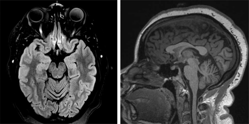 NUS1 variants can be associated with mild cerebellar atrophy