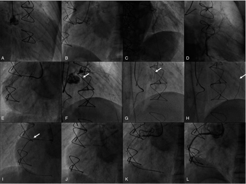 Retrograde recanalization of native right coronary artery chronic total ...