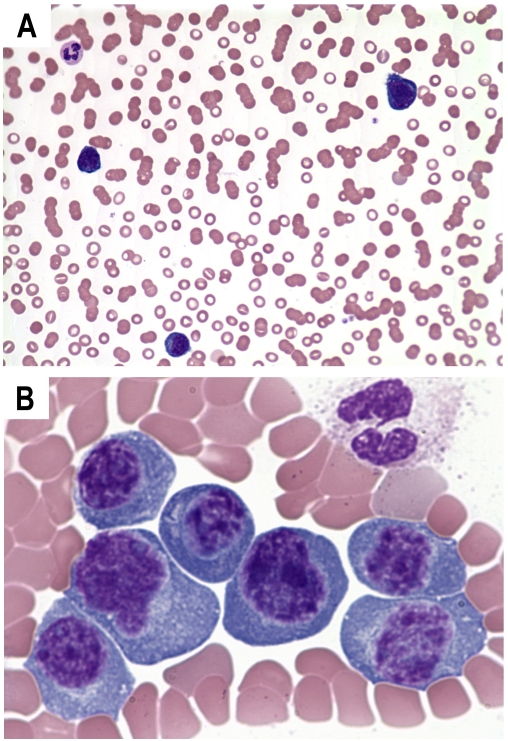 Peripheral blood polyclonal plasmacytosis mimicking plasma cell ...