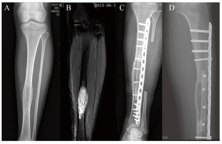 Long-Term Follow-Up of Biological Reconstruction with Free Fibular ...