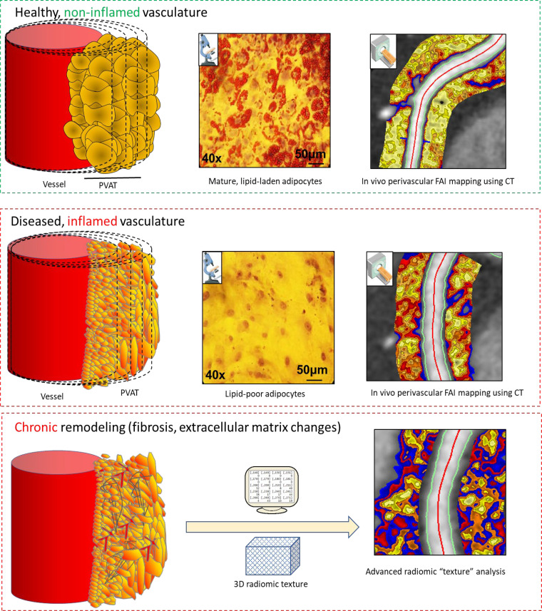 Inflammatory processes around the coronary arteries visualized by the fat attenuation index (FAI). In the presence of coronary inflammation, perivascular adipose tissue (PVAT) is characterized by a shift toward a greater aqueous and lower lipophilic content through inhibition of adipocyte differentiation and local activation of lipolysis. This phenotypic shift is reflected in CT attenuation gradients in the perivascular space detectable through the perivascular FAI. Perivascular adipocytes exposed to a low-inflammation environment versus a high-inflammation environment are characterized by a higher accumulation of intracellular lipid droplets, as indicated by the red color in the microscopy images, which correspond to Oil-Red-O staining. With chronic inflammation, there is eventual adverse fibrotic and other remodeling of the PVAT, which can be detected using advanced radiomic texture analysis of the perivascular fat. (Reprinted, with permission, from references 14 and 34.) 3D = three-dimensional.