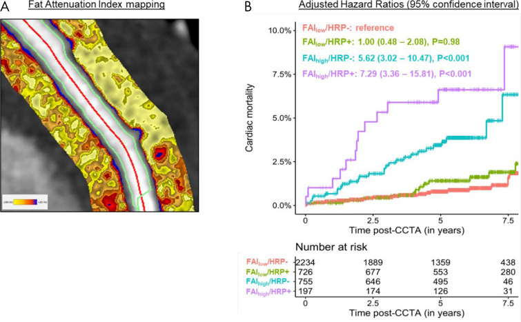 A, Fat attenuation index (FAI) mapping stratifies the cardiac risk associated with high-risk plaque (HRP) features. B, In the presence of a normal FAI (low FAI [FAIlow]), HRP features are not associated with an increased cardiac risk in the Cardiovascular Risk Prediction Using CT study population. However, in the presence of an abnormally elevated FAI, HRP features identify a truly “high-risk” population with a 6.26-fold higher adjusted cardiac risk compared with the FAIlow/HRP-negative reference group. (Reprinted, with permission, from reference 40.) CCTA = coronary CT angiography.