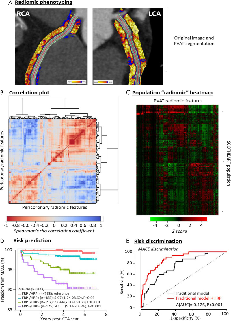 Radiomic phenotyping of coronary perivascular adipose tissue (PVAT). A, Radiomic mapping based on numerous shape-, attenuation-, and texture-related parameters in the pericoronary space of the right coronary artery (RCA) and left coronary artery (LCA). B, Correlation plot of all 1391 stable radiomic features in the Scottish CT of the Heart (SCOT-HEART) population (n = 1575 patients), with hierarchic clustering revealing distinct clusters of radiomic variance. C, Radiomic heatmap of the SCOT-HEART population. D, Prediction of major adverse cardiac events (MACE) in the SCOT-HEART trial for high versus low fat radiomic profile (FRP) values also stratified by the presence of high-risk plaques (HRPs). E, Improved MACE risk discrimination in the SCOT-HEART trial, with the use of the FRP performing over and above traditional risk factors as indicated by the change in the area under the curve (AUC). (Reprinted from reference 45.) Adj. HR = adjusted hazard ratio, CTA = CT angiography.