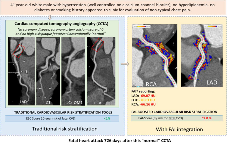 A case of fat attenuation index (FAI)–guided risk stratification. A 41-year-old male patient from the Cardiovascular Risk Prediction Using CT study with a history of hypertension who presented with atypical chest pain and was referred to undergo coronary CT angiography (CCTA) for further diagnostic evaluation. Left: Despite no evidence of coronary artery disease, a calcium score of zero, and a low European Society of Cardiology (ESC) risk score for 10-year fatal cardiovascular disease (CVD), the patient experienced a fatal myocardial infarction 726 days after his initial imaging. Right: FAI mapping revealed elevated values around most coronary vessels, suggestive of coronary inflammation, with a FAI-guided risk score retrospectively reclassifying his risk of adverse cardiovascular events to a higher risk group. This supports the notion that coronary inflammation captured by the perivascular FAI precedes the plaque formation and predicts events many years in advance, even before any sign of plaque or calcification is developed. D1 = first diagonal, LAD = left anterior descending artery, LCX = left circumflex artery, OM1 = first obtuse marginal artery, RCA = right coronary artery.