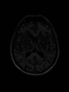 MRI showing low signal in T1