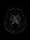 MRI showing High signal in T2 weighted sequence