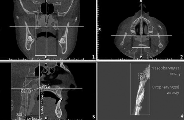 Figure 3. Three-dimensional measurement of pharyngeal airway volumes.