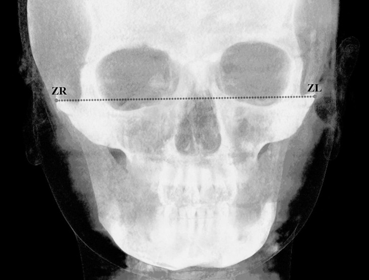 Figure 2. Measurement used on the frontal radiographs (bizygomatic width) obtained from CBCT.