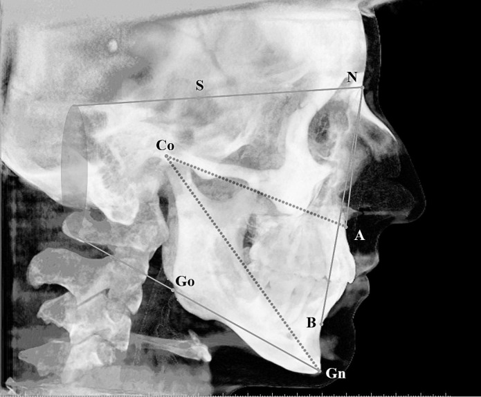 Figure 1. Cephalometric measurements used in the present study: SNA (°), SNB (°), ANB (°), SN-MP (°), Co-A (mm), and Co-Gn (mm).