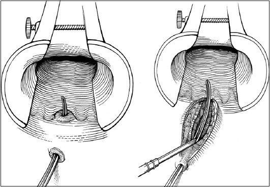 Benign anorectal disease: hemorrhoids, fissures, and fistulas - PMC