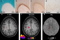 Figure 2: Histological and imaging detection of chronic active
lesions.