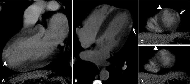 Images from coronary CT angiography with late enhancement protocol. A, Two-chamber,B, four-chamber, and, C, D, short-axis views show late-enhancing mesoepicardial area (arrow) in the lateral apical segment suggestive of myocarditis and a subendocardial area (arrowhead) in the anterior apical segment suggestive of myocardial infarction.