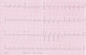 Electrocardiogram reveals diffuse ST-segment elevation.