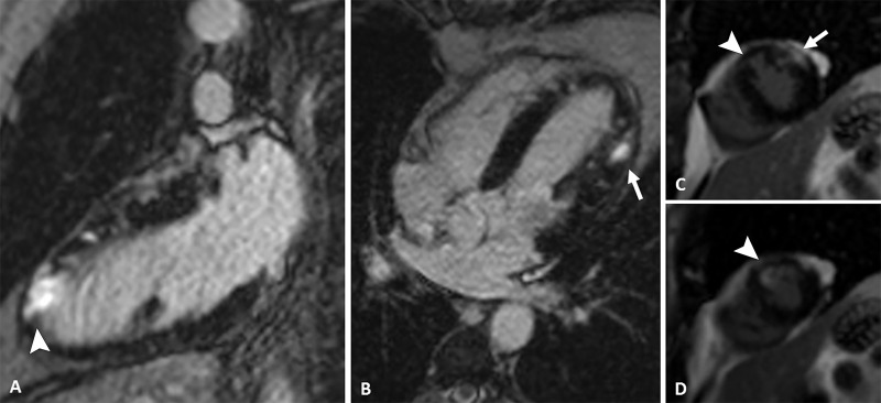 Images from phase-sensitive inversion-recovery cardiac MRI. A, Two-chamber, B, four-chamber, and, C, D, short-axis views show late-enhancing mesoepicardial area (arrow) in the lateral apical segment suggestive of myocarditis and a subendocardial area (arrowhead) in the anterior apical segment suggestive of myocardial infarction.