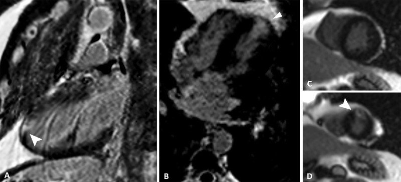 Images from phase-sensitive inversion-recovery cardiac MRI. A, Two-chamber, B, four-chamber, and, C, D, short-axis views show late-enhancing subendocardial area (arrowhead) in the anterior apical segment suggestive of myocardial infarction. The late-enhancing mesoepicardial area in the lateral apical segment, compatible with myocarditis in the previous examination, was no longer seen.