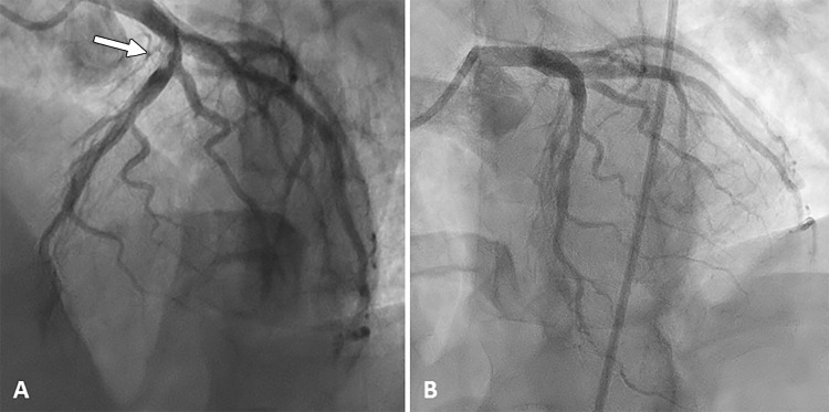 Images from coronary angiography. A, An ulcerated lesion causing 80% luminal narrowing in the proximal segment of the anterior descending artery, with a high thrombotic burden (arrow). B, After percutaneous coronary intervention with a drug-eluting stent.