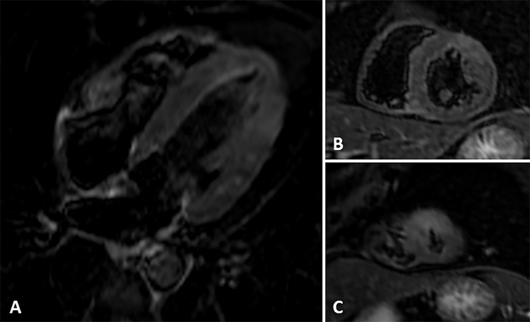 Images from short τ inversion recovery cardiac MRI. A, Four-chamber and, B, C, short-axis views show edema in the mid anterolateral wall and lateral apical wall and in the anterior apical segment..