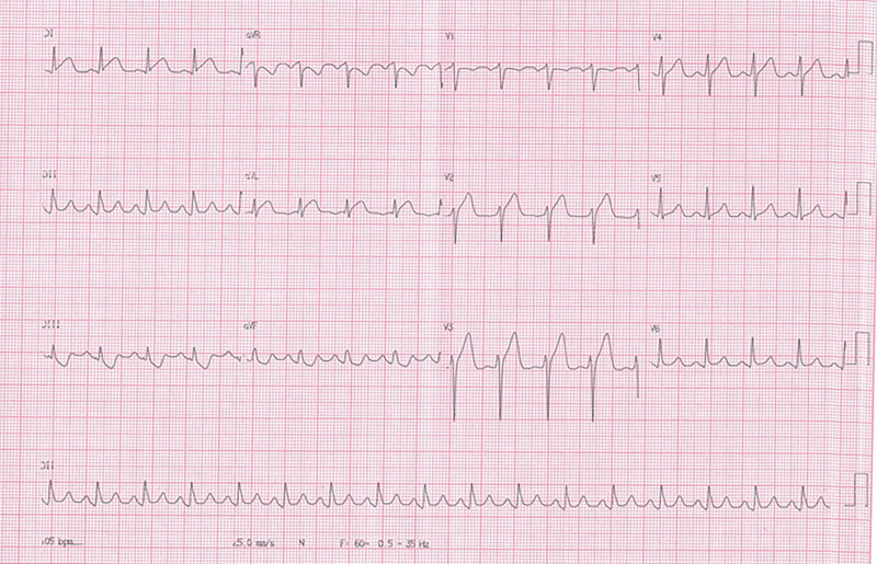 Electrocardiogram reveals diffuse ST-segment elevation.