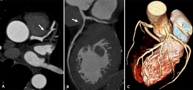 Images from coronary CT angiography. A, Axial, B, oblique multiplanar reconstruction, and, C, tridimensional reconstruction show an atherosclerotic plaque (arrow) in the proximal segment of anterior descending artery with severe luminal narrowing.