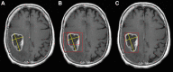 Example of the automated line annotation to bounding box transformation.
(A) The cystic and solid high-grade glioma is annotated with two line
measurements mined from the picture archiving and communication system. (B) The
curation pipeline geometrically squares the line annotations to generate two
overlapping bounding boxes. (C) These, in turn, are converted to a single
bounding box encompassing the entire lesion.