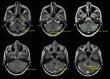 Example of three-dimensional lesion identifications after automatic
linking of adjacent two-dimensional boxes. Several consecutive held-out test
images from one MRI series are shown through the posterior fossa, simulating
model performance on a full stack of contiguous axial postcontrast T1-weighted
images. Yellow boxes denote the predictions of the Mask region-based
convolutional neural network model after self-labeling. Each prediction box
includes an automatically generated lesion identification and confidence score.
Green boxes denote ground truth annotations generated from mined tumor line
annotations.