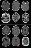 Representative false-positive and false-negative predictions from the
best-performing Mask region-based convolutional neural network detection model
trained using the self-labeling expanded training data set. (A) False-positive
predictions included choroid plexus (top left and top right), superior sagittal
sinus imaged in cross section (bottom right), small vessel loops (top middle),
petrous apex (bottom left), and apparent artifact within the mobile tongue
(bottom middle). (B) False-negative predictions included extra-axial tumors (top
right, bottom left, and bottom middle), probably reflecting a relatively limited
representation of these types of lesions within the training data set, and
faintly enhancing (top left) and leptomeningeal (top middle and bottom right)
lesions. Solid boxes represent ground truth, and dashed boxes represent model
predictions. White solid boxes are correctly detected ground truth boxes. Red
solid boxes are for false-negative predictions. Red dashed boxes are for
false-positive predictions. Dashed blue boxes are for true-positive
predictions.