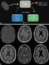 (A) Schematic drawing of the semisupervised learning (self-labeling)
approach to automated tumor detection. The baseline model trained from noisy
incompletely labeled mined images is used to identify unlabeled tumors on an
expanded training image set containing 213 652 axial postcontrast
T1-weighted images. After this cycle, a new detection model is trained from
scratch using the expanded bounding box training data set, which is used to
identify additional unlabeled tumors on the training image set. Twelve
self-labeling cycles were completed, increasing the number of training bounding
boxes from 10 623 to 29 185. (B) Example training bounding boxes
added during self-labeling process. Blue boxes represent new lesion annotations
added during self-labeling. Green boxes are baseline training annotations
automatically generated from line annotations mined from the picture archiving
and communication system.