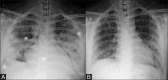 Figure 11 (A and B)
