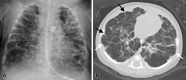 CLD of prematurity and pulmonary hypertension in a 2-month-old female
infant. (A) Chest radiograph shows bilateral diffuse coarse interstitial
lung markings with marked overinflation of the lungs and bilateral
air-filled cystic spaces (right more than left). (B) Axial chest CT image
(lung window) shows bilateral cystic changes with intercostal bulging (white
arrows), subpleural triangles, and septal fibrosis (black
arrows).