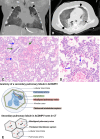 Alveolar capillary dysplasia and pulmonary hypertension in an
8-month-old infant. (A, B) Coronal (A) and axial(B) CT images (lung windows)
show bilateral diffuse hazy ground-glass opacities (arrow), with
preferential involvement of the perihilar regions and lower lobes. There is
relative sparing of the upper lobes and the most peripheral regions of the
lungs (arrowheads) and dependent atelectasis in B. (C) Photomicrograph of
specimen shows slightly widened alveoli. The pulmonary artery (blue arrows)
shows medial hypertrophy, and there are abnormal thin-walled muscular veins
(green arrows) in the bronchovascular bundle. (Hematoxylin-eosin [H-E]
stain; original magnification, ×10.) (D) Higher-power photomicrograph
shows widened septa, with capillaries that are centrally located away from
the epithelial interface (arrows). (H-E stain; original magnification,
×20.) (E) Illustration shows abnormal positioning of pulmonary veins
and thickening of the interlobular septum.