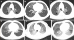 NEHI in a 2-year-old child. (A–D) Axial inspiratory (A, B) and
expiratory (C, D) CT images show central paramediastinal ground-glass
opacities in both upper lobes (arrows in A and C), and geometric areas of
ground-glass opacities are seen in the right middle lobe and lingula (arrows
in B and D). Note that in inspiration and expiration, there are similar
findings of the remaining lung parenchyma, consistent with air trapping on
expiration. (E, F) Axial CT images acquired when the patient was 4 months
old show more diffuse ground-glass opacities, findings less classic for NEHI
than those on previous images.