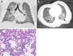 Pulmonary interstitial glycogenosis in a 2-month-old full-term infant.
(A, B) Coronal (A) and axial (B) CT images (lung windows) show bilateral
patchy ground-glass airspace opacities (arrows) and centrilobular nodules in
the dependent upper and lower lobes. (C) Photomicrograph of specimen shows
mildly enlarged alveoli, but the septa are widened by bland mononuclear
cells with clear cytoplasms. There is minimal intra-alveolar material, and
type 2 pneumocytes are not prominent. (Hematoxylin-eosin stain; original
magnification, ×200 [objective, ×20].)