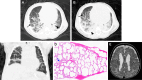 Severe pulmonary hypertension secondary to pathogenic FLNA mutation in
a 3-month-old infant. (A, B) Axial CT images (lung window) during
inspiration show bilateral interlobular septal thickening (arrow) and
perihilar-predominant consolidation (arrowhead). (C) Coronal CT image (lung
window) shows mosaic attenuation of the lung parenchyma on expiration, which
is suggestive of airtrapping. Patchy airspace opacification at the posterior
bases of both lungs likely represents dependent atelectasis. (D)
Photomicrograph of specimen shows the alveoli markedly enlarged, with mild
thickening of some alveolar septa. The pulmonary artery (arrow) shows severe
intimal fibrosis with a small residual lumen. (H-E stain; original
magnification, ×4 on a digital scale.) (E) Axial T2-weighted MR image
through the lateral ventricles shows gray matter heterotopia lining both
ventricles (arrows), which are also notably dilated.
