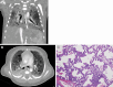 ILD due to biallelic ABCA3 mutations in a 2-week-old neonate. (A, B)
Coronal (A) and axial (B) CT images (lung windows) show diffuse ground-glass
opacities with mild interlobular septal thickening (arrow). (C)
Photomicrograph of specimen shows widened alveolar septa with a combination
of smooth muscle, inflammatory cells, and fibroblasts. Most septa are lined
with reactive type 2 pneumocytes, and there are foci of intra-alveolar
macrophages. Intra-alveolar surfactant material is not present in this
field. Note that lung biopsy was performed before the availability of
genetic results because of clinical concern for ACDMPV. (Hematoxylin-eosin
stain; original magnification, ×100 [×10
objective].)