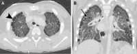Subpleural cysts in in a 5-year-old child with trisomy 21 and
ventricular septal defect. Axial (A) and coronal (B) CT images of the chest
(lung window) show diffuse subpleural cysts of various sizes extending along
the periphery (arrowhead in A) and into the fissures (arrow in
B).
