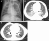 SFTPC mutation in a 3-month-old infant. (A) Chest radiograph shows
early findings of diffuse hazy opacities and hyperinflation. (B) Axial CT
image shows patchy ground-glass opacities (arrow). (C) Axial CT image
acquired when the patient was 8 years old shows chronic findings that
include diffuse ground-glass opacity as well as cystic changes
(arrowhead).