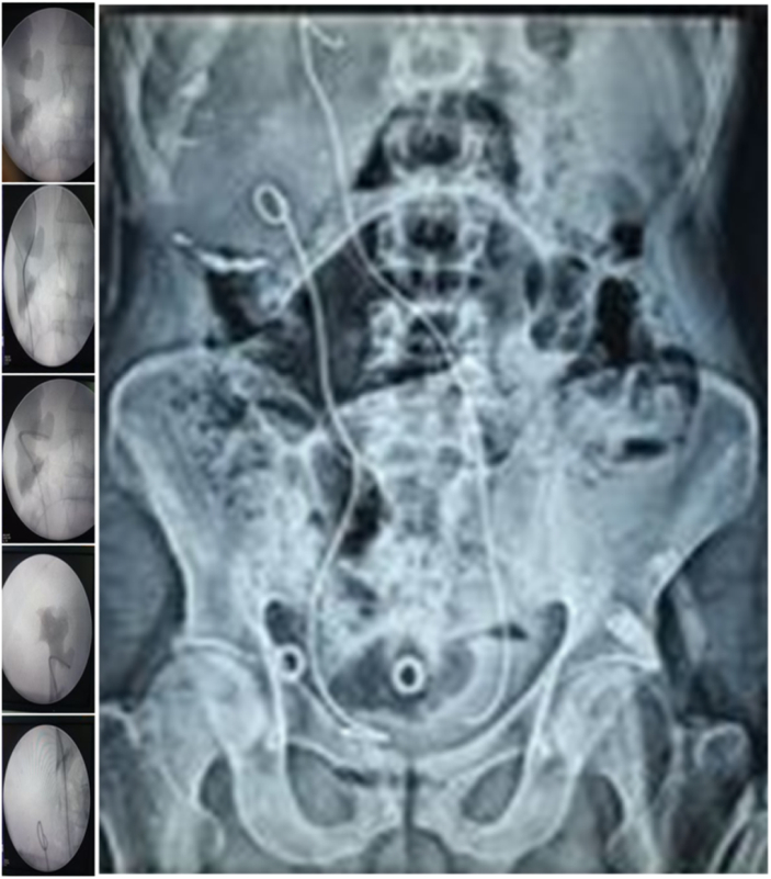 Crossed-fused renal ectopia with renal calculi and its management, a ...