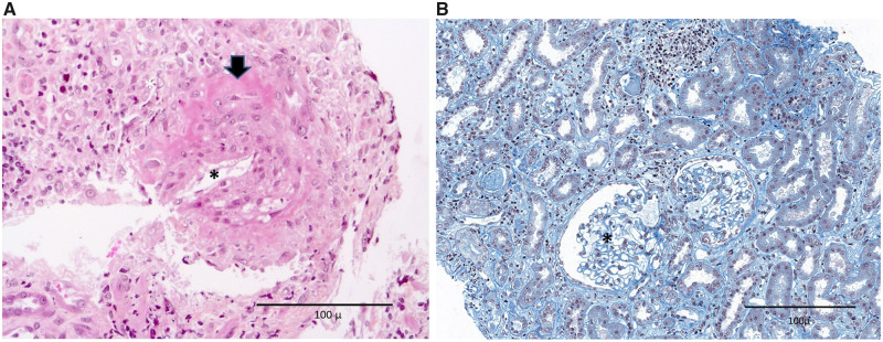 FIGURE 1: Renal vasculitis associated with COVID-19.