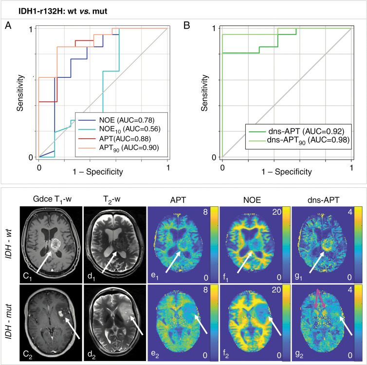 Chemical exchange saturation transfer (CEST) MRI can noninvasively help to predict histopathologic characteristics to help identify patients who are more radiosensitive and can therefore potentially be used to adapt treatment. For example, CEST helped to predict the status of isocitrate dehydrogenase (IDH) mutation in patients with recently diagnosed untreated glioma. A, B, Amide proton transfer (APT) and downfield nuclear Overhauser effect (NOE)-suppressed (dns) APT (dns-APT) CEST metrics allowed prediction of isocitrate dehydrogenase mutation status with highest area under the curve (AUC) for the dns APT90 metric (metric, 0.98) and a test sensitivity and specificity of 0.95 (95% CI: 0.77, 1.00) and 1.00 (95% CI: 0.59, 1.00), respectively (P < .001). Two example patients with newly diagnosed glioblastoma IDH-wt (c1–g1) and IDH-mut (c2–g2) are shown. C1 shows gadolinium contrast-enhanced (Gdce) T1-weighted (T1-w) MRI scans, and d1 shows T2-weighted (T2-w; turbo spin echo), relaxation-compensated multipool CEST MRI at 7.0-T with (e1) separated APT, NOE (f1), and dns-APT (g1) effects. A ring-like hyperintensity can be delineated in the periphery of the IDH-wt glioblastoma at dns-APT imaging (g1, white arrow), whereas the IDH-mut glioblastoma appears barely hyperintense at dns-APT (g2, white arrow). The head of the caudate nucleus also appears hyperintense on dns-APT images (g2, pink arrows). White arrows indicate the location of the tumor. Reprinted, with permission, from reference 62.