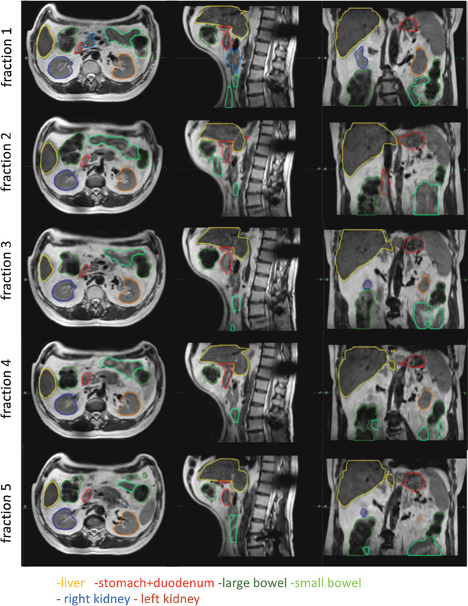 Interfraction motion of organs at risk (liver, bowel, kidney, stomach, and duodenum) in a patient with pancreas cancer undergoing five-fraction stereotactic body radiation treatment (10 Gy × 5) on the Elekta 1.5-T MRI-guided linear accelerator. The ability to adapt treatment according to the position of the organs at risk increased safety of the procedure. Figure used, with permission, from Dr Neelam Tyagi, Memorial Sloan-Kettering Cancer Center.