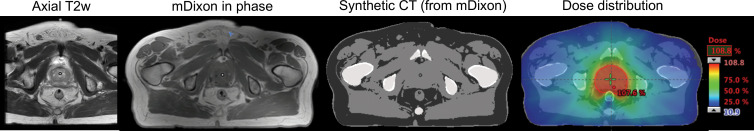 Offline MRI-guided RT of a patient with prostate cancer. The axial T2-weighted (T2w) image is used for diagnostic purposes, and the modified Dixon (mDixon) in-phase image is used for treatment planning. A synthetic CT image is created with an artificial intelligence algorithm from the mDixon image and is then used to compute the dose distribution. Figure adapted, with permission, from Dr Neelam Tyagi, Memorial Sloan-Kettering Cancer Center.