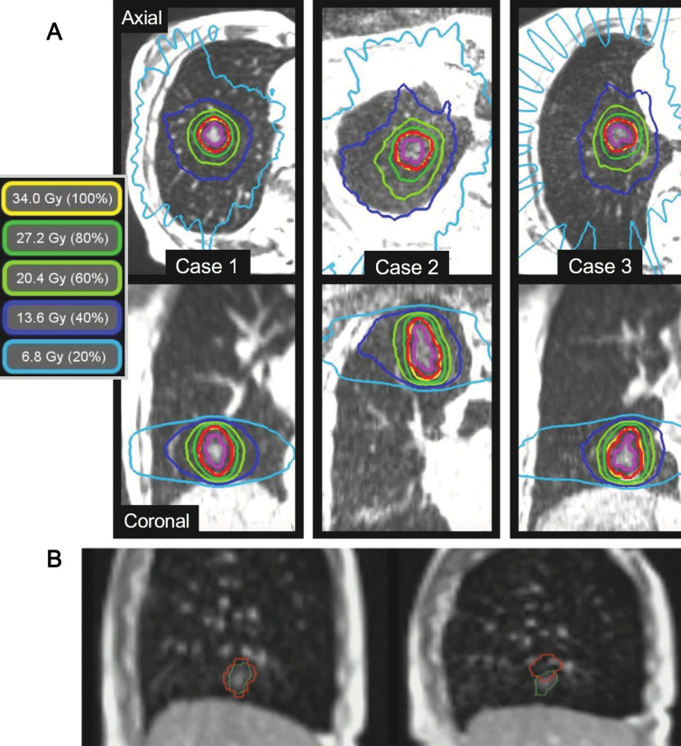 Single-fraction motion-gated lung stereotactic ablative radiation therapy by using the ViewRay 0.35-T MRI-guided linear accelerator system. A, Treatment plan for the first three patients, where one fraction of 34 Gy is delivered to the planning target volume (red). The planning target volume is created by adding a 5-mm isotropic margin to the breath-hold gross tumor volume (purple). B, Real-time two-dimensional motion tracking of the gross tumor volume (green) in one of the patients, which is performed by using two-dimensional images acquired in sagittal orientation every 250 msec and deformable image registration. During delivery, the beam is automatically turned off when a specified proportion of the gross tumor volume is outside the gating window (red). In B, on the left-hand image the full gross tumor volume is contained within the gating window, whereas on the right-hand image, about 75% of the gross tumor volume is outside the gating window. Modified, with permission, from reference 30.