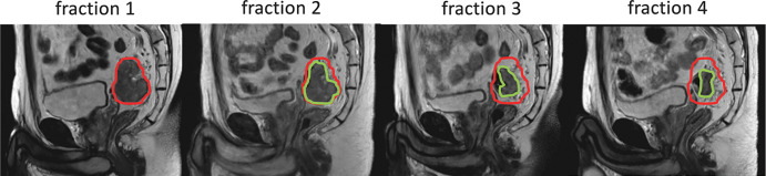 Interfraction adaptive treatment of a patient with rectal cancer on the Elekta 1.5T MRI-guided linear accelerator. Tumor contour for fraction 1 is shown in red and tumor contours for other fractions are shown in green. The ability to adapt treatment to the exact location and size of the tumor improved outcome and resulted in tumor remission. Figure adapted, with permission, from Drs Martijn Intven and Bas Raaymakers, University Medical Center Utrecht.