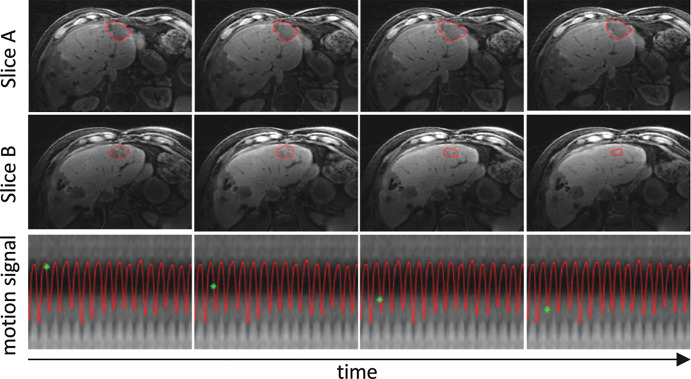 Real-time volumetric liver tumor motion tracking by using the MR Signature Matching technique for two representative sections. The tumor contour is shown in red. The motion-signal row shows the temporal location (green point) in the respiratory motion signal. Total imaging latency including data acquisition and image reconstruction for each three-dimensional image is about 250 msec. Access to real-time volumetric motion information would in principle allow continuous adaptation of the radiation beam to the tumor motion.