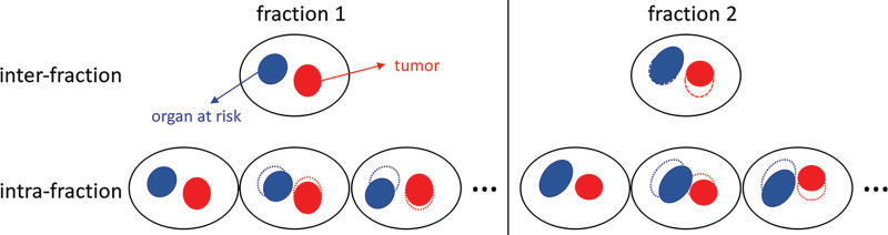 Schematic description of interfraction and intrafraction adaptation to organ motion by using online MRI-guided radiation therapy with a hybrid MRI-guided linear accelerator system. For interfraction adaptation, treatment is adjusted according to the image of the day (dashed lines show the position of the tumor and organ at risk for fraction 1). Intrafraction adaptation uses real-time imaging to adjust treatment according to continuous and/or sporadic organ motion within each fraction (dotted lines show the position of the tumor and organ at risk for the first point of real-time imaging).