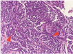 <b>Fig. 3</b>: Histological image showing glandular formations (red arrow) which is positive for pan-Cytokeratin, Epithelial Membrane Antigen (EMA) and Cytokeratin 7 (CK 7) antibodies. Other areas show predominantly spindled
malignant cells.