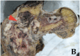 <b>Fig. 2b</b>: Cut section of the proximal femur showing the fleshy grey, haemorrhagic tumour (red arrow) involving the metaphysis and diaphysis. Note that there is minimal involvement of the surrounding soft tissue.