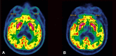 Hypermetabolism of the right putamen on FDG-PET, normalized after treatment with corticosteroids