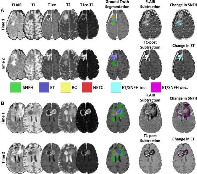 Representative examples of brain MRI and tumor segmentations in (A) a 55-year-old female patient with glioblastoma and (B) a 54-year-old female patient with glioblastoma. Subtraction images show representative segmentations of longitudinal (A) increases and (B) decreases in surrounding nonenhancing fluid-attenuated inversion recovery (FLAIR) hyperintensity (SNFH) and enhancing tissue (ET) in each patient, respectively. T1ce = T1 contrast-enhanced, RC = resection cavity, NETC = nonenhancing tumor core.